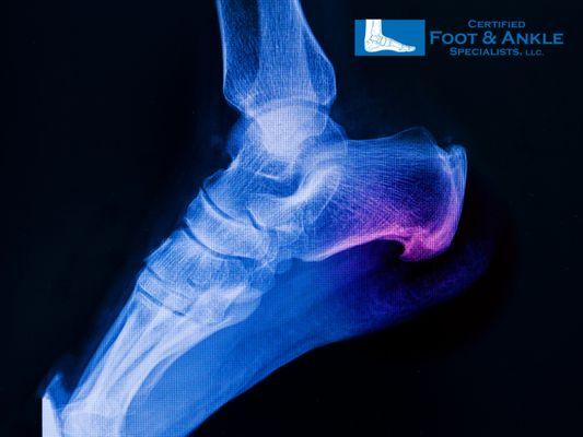 Painful Heel Spur Treatment in West Palm Beach Florida