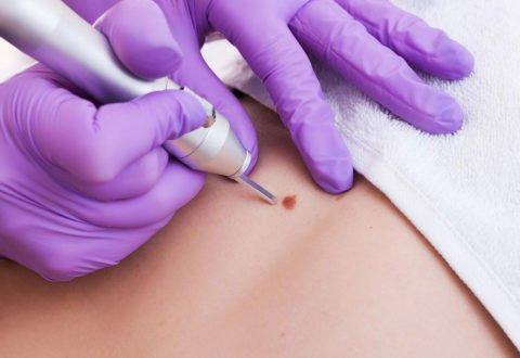 Skin Tag, Warts, Mole Removal