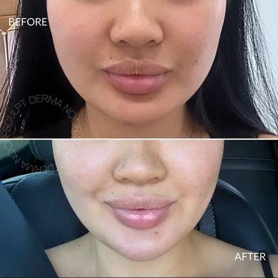 Facial slimming with Dysport injections