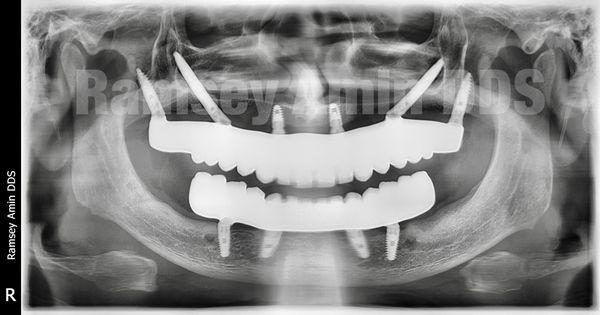 X-ray of zygomatic and Pterygoid full mouth implants