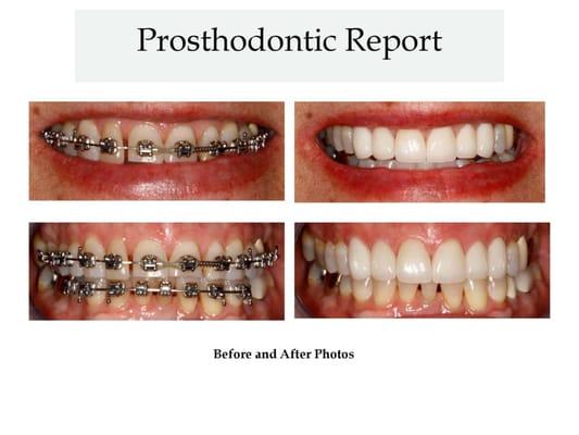 Porcelain Veneers