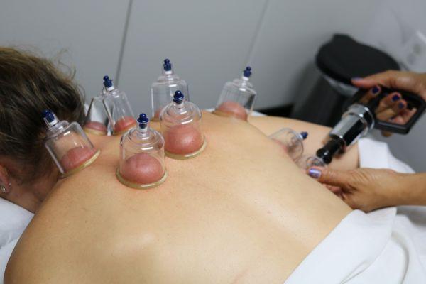 Cupping therapy