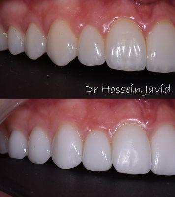 Replacing 10 Veneers Done twice by 2 different Doctors, both in #Beverly Hills