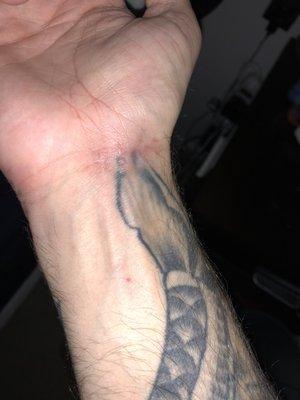 Healed after surgery for most part.