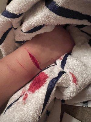 This is how my wound looked like originally, (before It was cleaned) it is a deep cut to the point where you can see tissue