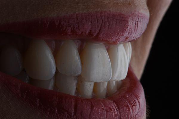 Porcelain Veneers