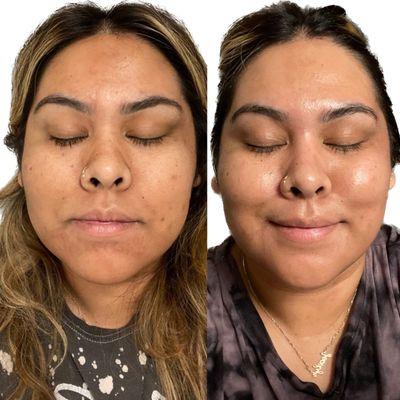 Before and After The Perfect Derma Peel - A medical grade peel 
The goal was to lighten pigmentation and even out skin tone