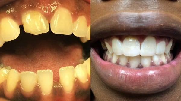 Composite Bonding- Before and after