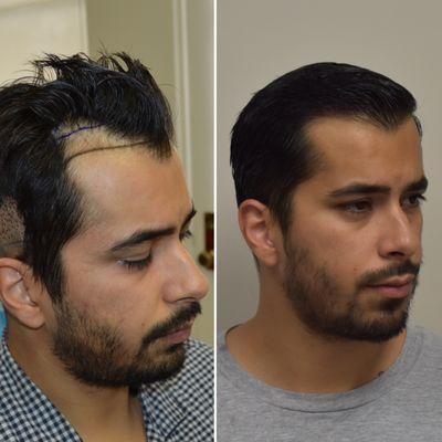 6 months post FUE Hair Transplant @50% growth. Double density still to come following next 10 months. Client had zones 1 and 2 restored.