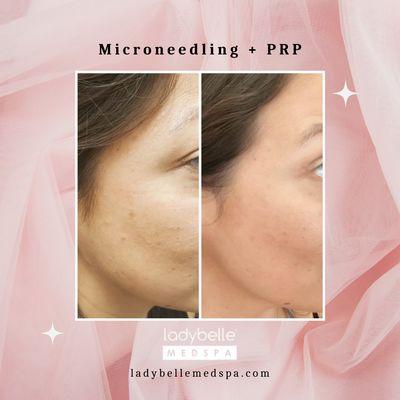 Improve skin texture, reduce fine lines and brighten your complexion with Microneedling + PRP