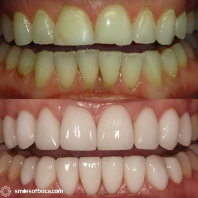 Veneer restoration