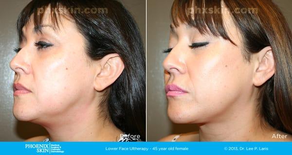 Ultherapy Skin Tightening Treatment!  Try it today - no downtime!