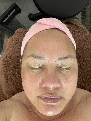 Chemical peel