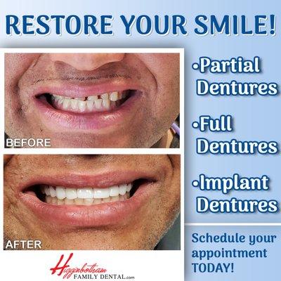 Partial, full, and implant dentures in Memphis, TN