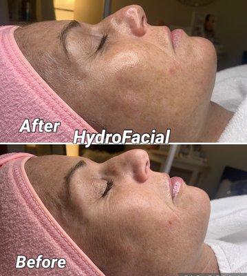 HydroFacial