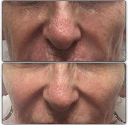 Fat loss occurs with aging.  Cheek augmentation with Voluma.