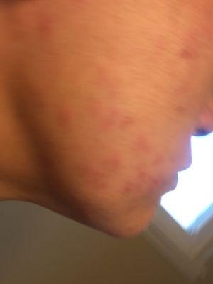 Not: i don't have bad acne. This is the result of excessive extractions after is asked them to stop twice