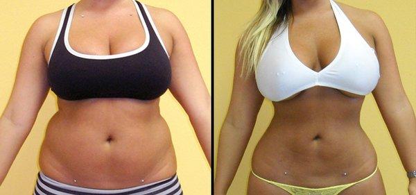 Before & After  Non-Invasive Laser Lipo