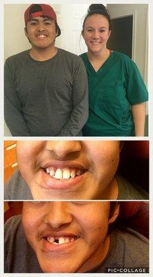 Check out this beautiful partial made for an amazing kid. Long weeks of waiting for his new tooth paid off! Above is Kimberly with our new p