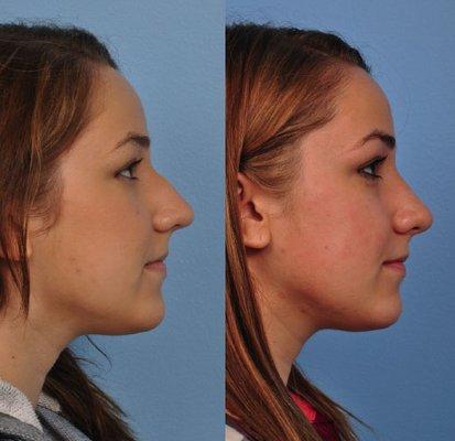 Rhinoplasty