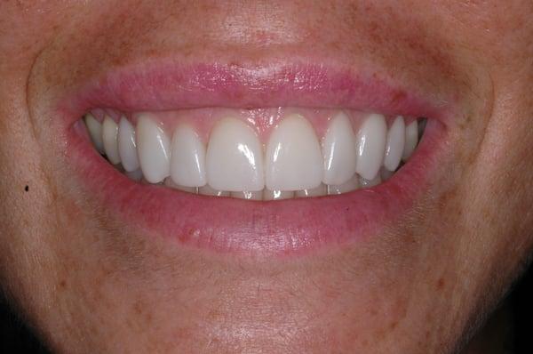 After. Conservative preparation, pressable ceramic veneers. (dentistry performed by Dr. Sullivan)