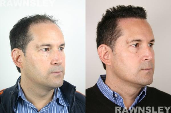 Rawnsley Hair Restoration