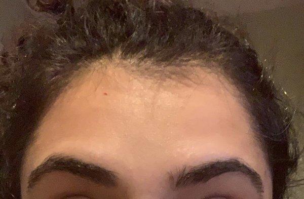 After: pulling my eyebrows to the max and not a single line on my forehead