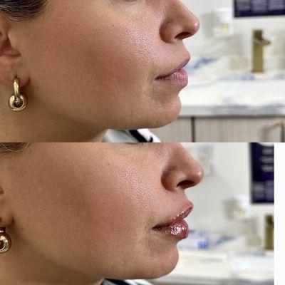 Lips, Juvederm Ultra, Lip Fillers