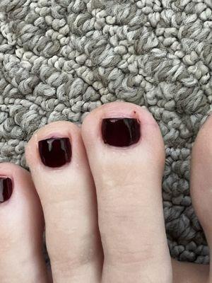 Bleeding and exposed nail beds