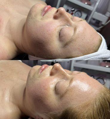 Classic Facial with Added on Hydro Jelly Mask