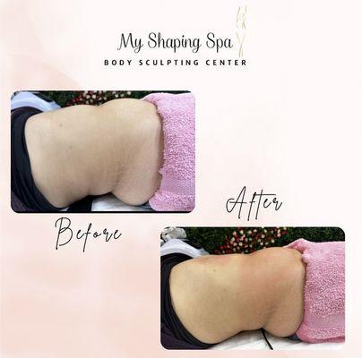 4cm down with our Cryolipolysis treatment.