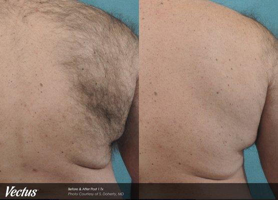 Laser Hair Removal