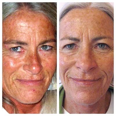 Before and after picture of a client, with severe sun damage. She used our regimen of home care and monthly treatments.