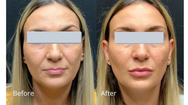 Patient treated with Bellafill on cheeks, Juvederm for lips & Botox to correct eyebrow alignment.