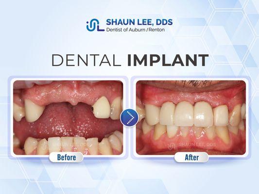 Shaun Lee, DDS Family Emergency Dental Implants of Renton | 10700 SE 174th Street, Suite 204, Renton, WA