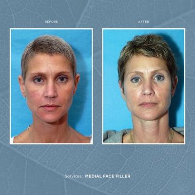 Medial Face Filler Before & After