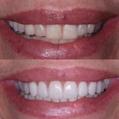 20 Porcelain Veneers Thousand Oaks