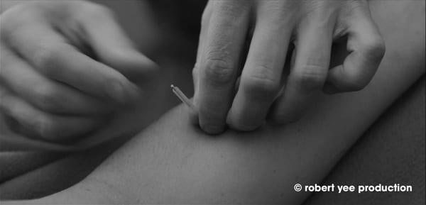 Community Supported Acupuncture