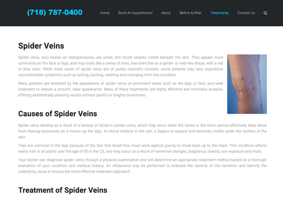 Spider Veins Treatment