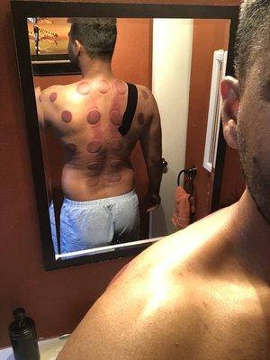 First time cupping