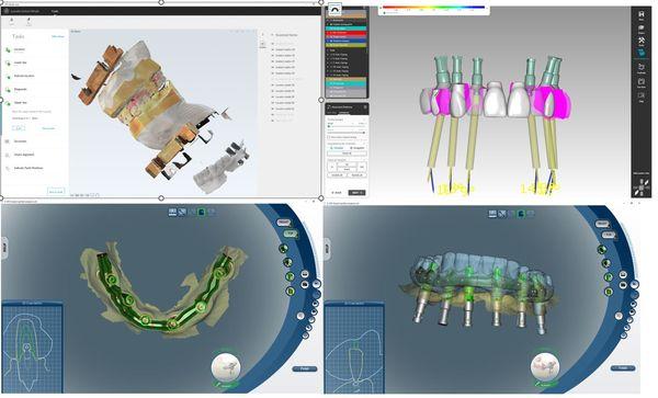 The only prosthodontist northern California with in house CAD design for complex cases