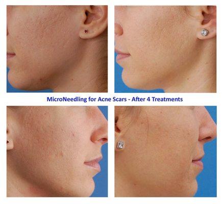 Microneedling for acne scars