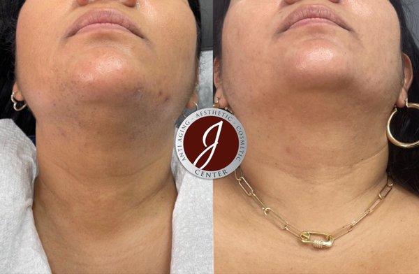 Laser Hair Removal done on Chin