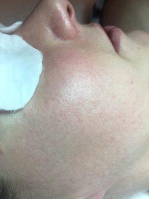 After Microneedling treatment