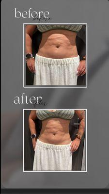 Body sculpting ~ combo treatment to get rid of stubborn fat and love handles!