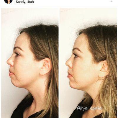 Chin filler is the ultimate tool for slimming your face and adding symmetry