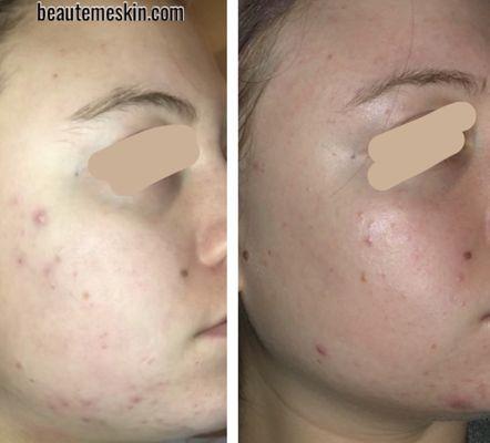 Teen acne control treatment