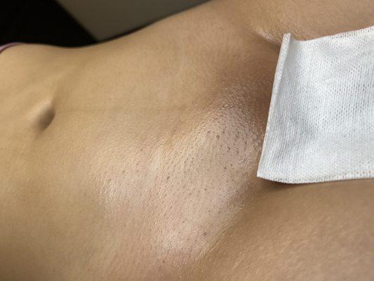 After sugar hair removal Brazilian