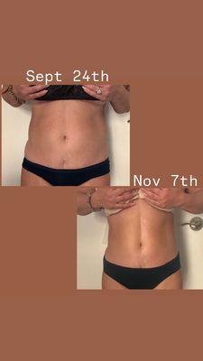 Body Sculpting Before and After 6 sessions