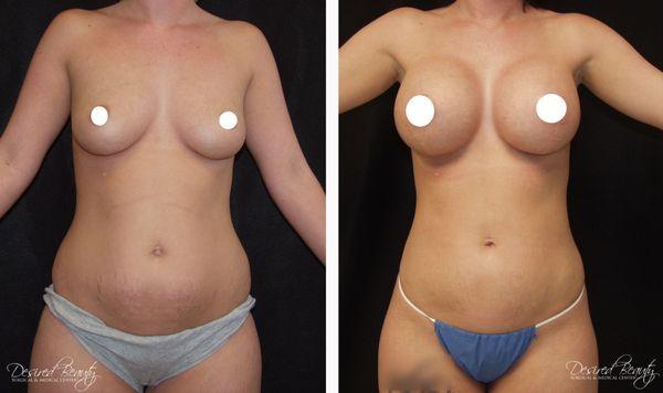 Breast Augmentation & Liposuction (Mommy Makeover) Before & After